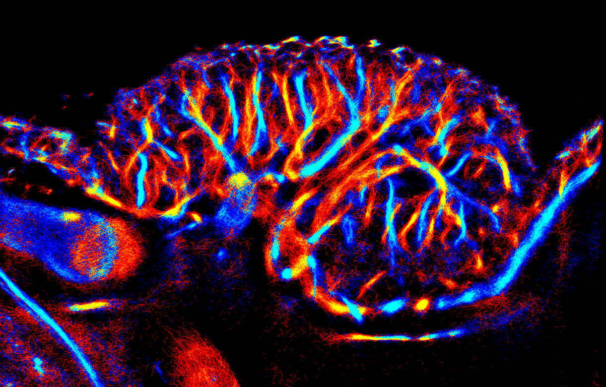 A super-resolution ultrasound localization microscopy (ULM) imaging of a tumor. This image shows the directional flow mapping of the tumor that distinguishes between feeding and draining vasculature.